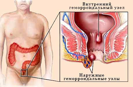 Как проводится лечение в домашних условиях геморроя