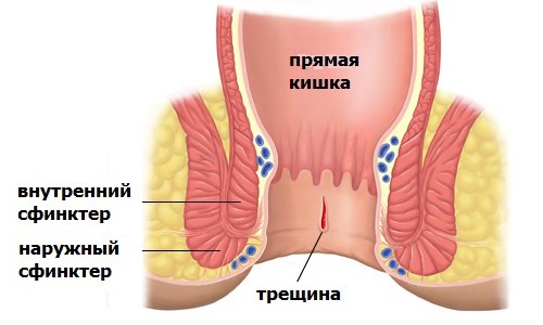 Анальная трещина: домашний уход по плану врача и признаки для обращения