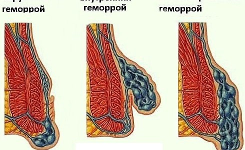 Геморрой: чем лечить заболевание у женщин