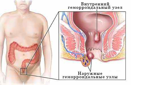 Виды геморроя Виды геморроя